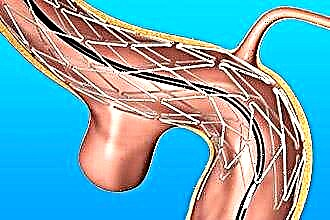 Анеуризма каротидне артерије: симптоми, дијагноза и лечење