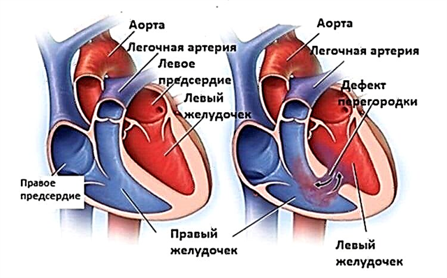 Iedzimtu sirds defektu cēloņi, pazīmes, diagnostika un ārstēšana