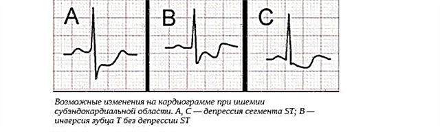 Subendocardialis és subepicardialis ischaemia: mi ez?