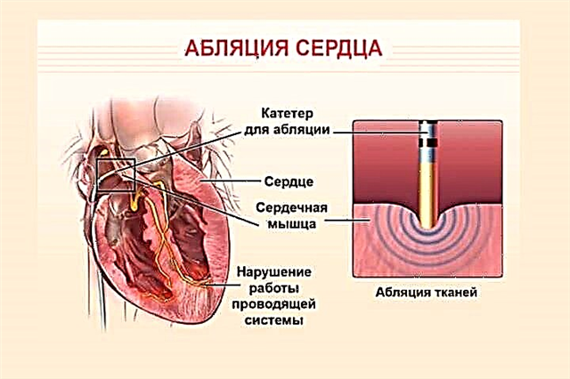 Radiofrekvenčna ablacija srca (RFA): tehnika, pregledi in stroški