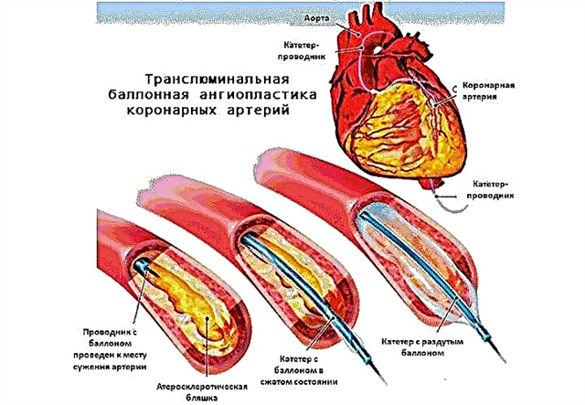 Stenting des vaisseaux cardiaques - description, indications, espérance de vie et avis