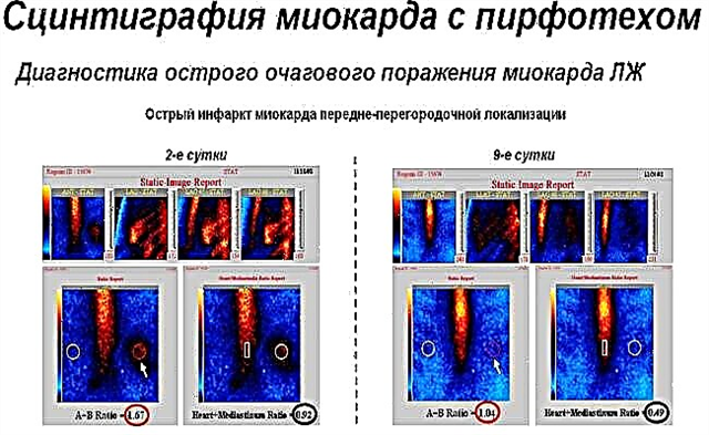 Myocardial scintigraphy: indications, technique, cost