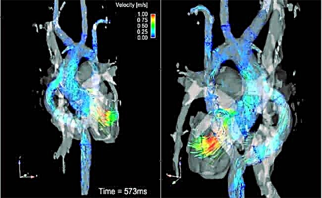 Wat kan een MRI van het hart laten zien?