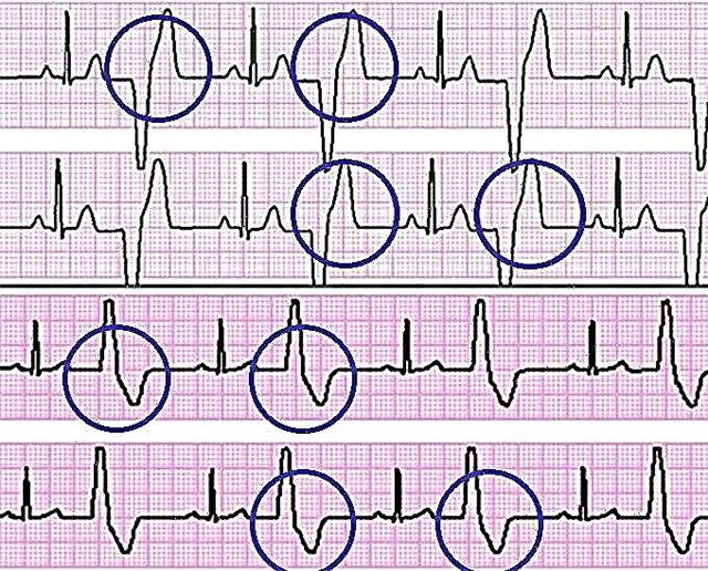 Extrasystole pada kardiogram: apakah itu, apakah sebabnya, peringkat tindakan