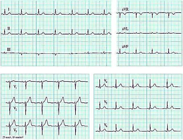 Кардиограм срца и његово декодирање - како се то ради и у којим случајевима