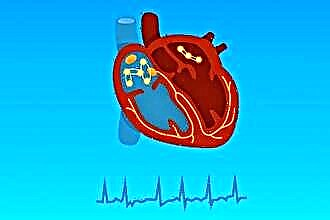 Kardiopatia dysplastyczna