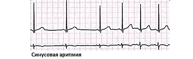 What does sinus arrhythmia mean and how dangerous it is