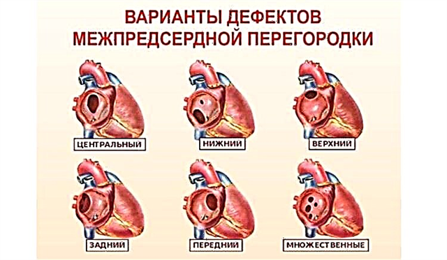 Defek septum ventrikel: gejala dan perawatan bedah