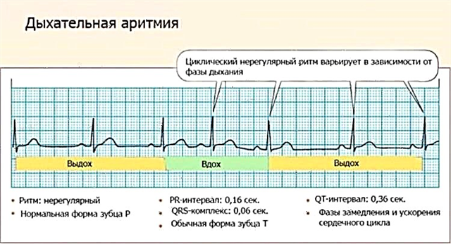 Arrhythmia and pregnancy: the right approach