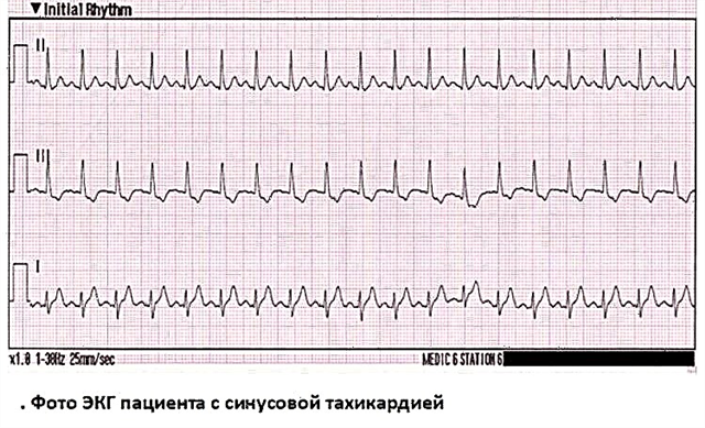 What is sinus tachycardia: why it appears and what is its danger