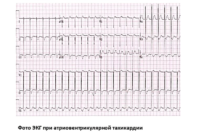 What is supraventricular (supraventricular) tachycardia and how to treat it: combating paroxysms