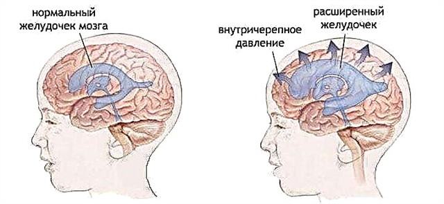 Intracranial pressure - symptoms and treatment for an increase