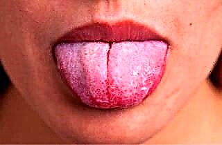 Lingual tonsils
