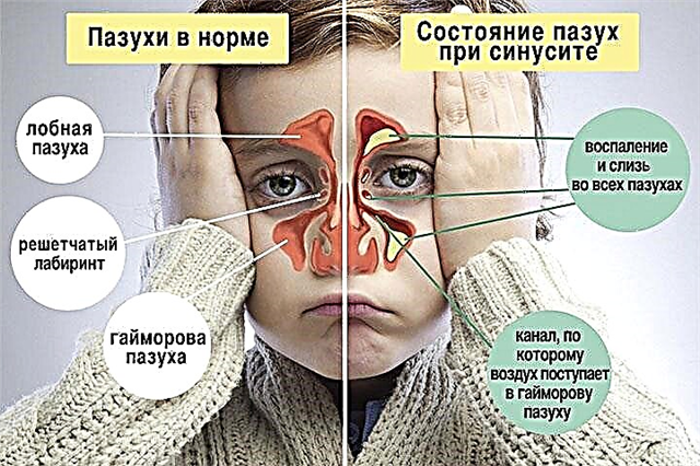 Maxillary or maxillary sinuses