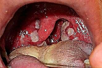 How to treat purulent sore throat in an adult