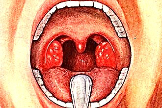 Đau thắt ngực - một lớp phủ trắng trên lưỡi