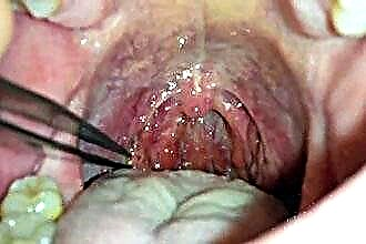 How to distinguish sore throat from flu?