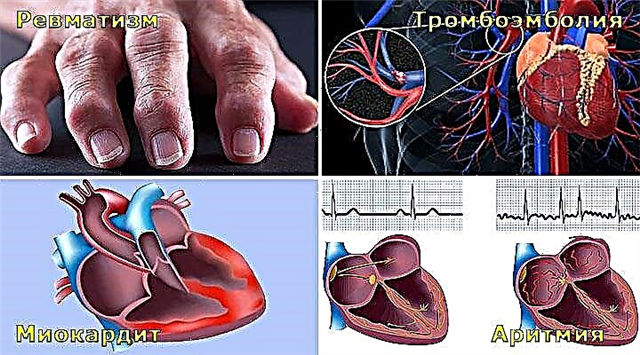 Kako angina vpliva na srce?