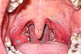 Signs and symptoms of purulent sore throat