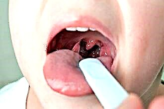 Tratamiento de la garganta para la angina