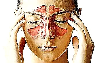 Causas de angina frecuente en adultos.
