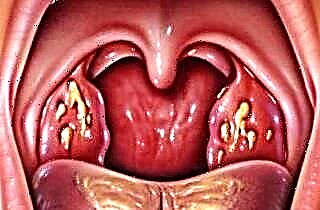 Purulent sore throat in adults