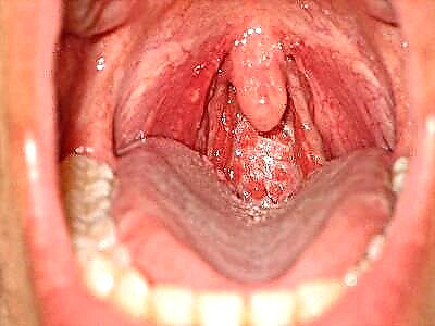 Cos'è il mal di gola lacunare