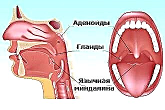 อะไรคือความแตกต่างระหว่าง lacunar angina และ follicular?