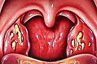 Varietà di mal di gola