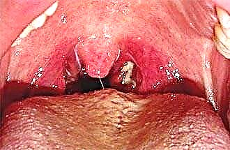 Ulcerös nekrotiserande tonsillit