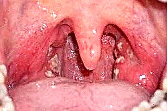 Treatment of streptococcal sore throat