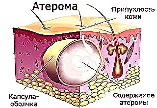 Атерома за вухом
