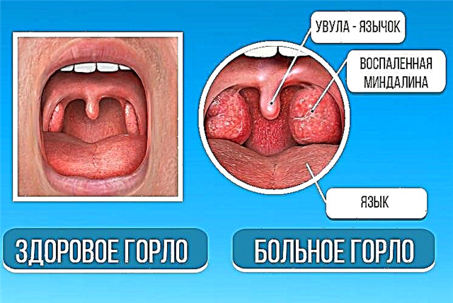 Treating a swollen uvula in the throat