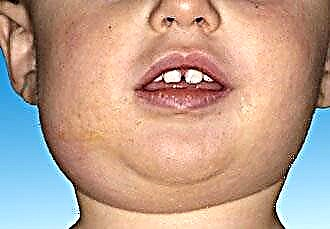 How to relieve swelling of the throat in a child