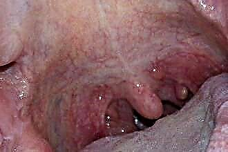 Throat cyst treatment