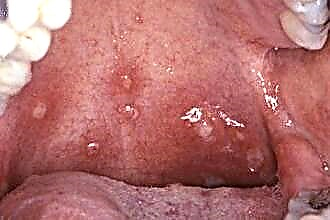 Znakovi herpesa u grlu kod odraslih