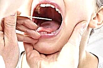 Treatment of phlegmonous sore throat
