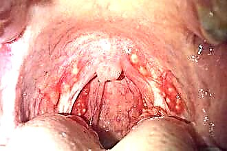 Zakaj se akne pojavijo na zadnji strani grla?