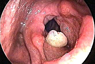 喉の腫瘍学