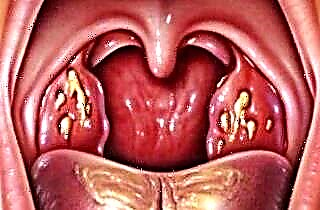 Hva er dekompensert tonsillitt?