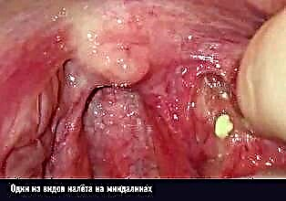 Gejala tonsillitis