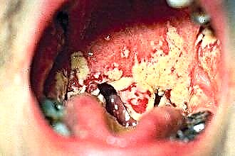 Принципи лікування грибка кандиди у горлі