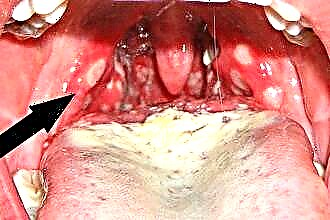 Årsager til udseendet af svamp i halsen og tonsil candidiasis