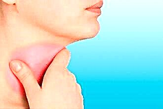 De viktigaste symptomen på faryngomykos i halsen