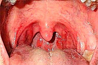 The effect of pharyngitis in a pregnant woman on a child