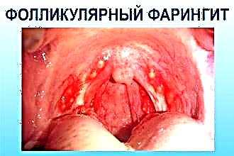 Treatment of purulent pharyngitis