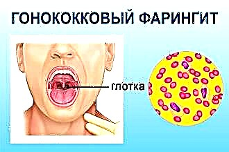 Gonokoki farüngiidi sümptomid ja ravi