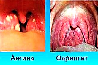 인두염과 편도선염의 차이점은 무엇입니까?