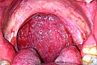Lėtinio faringito simptomai