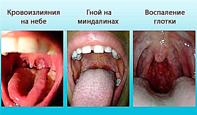 Streptococcal pharyngitis symptoms